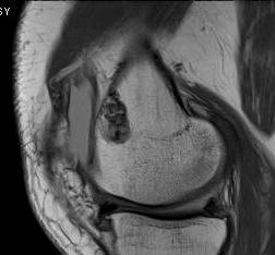 MRI Enchondroma0001